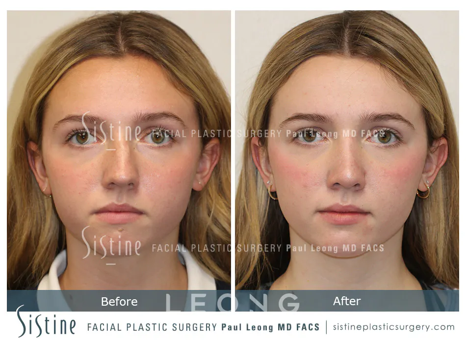 Rhinoplasty Before and After | Leong Facial Plastic Surgery