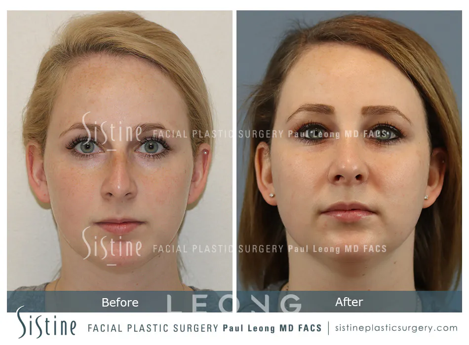 Rhinoplasty Before and After | Leong Facial Plastic Surgery