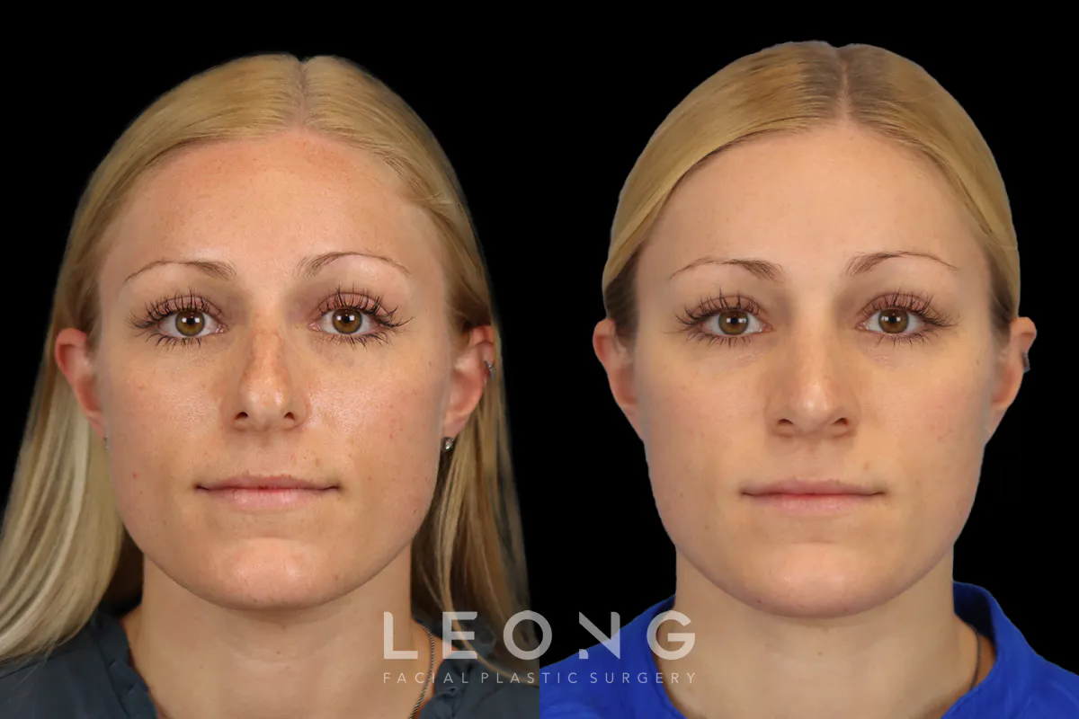 Rhinoplasty Before and After | Leong Facial Plastic Surgery