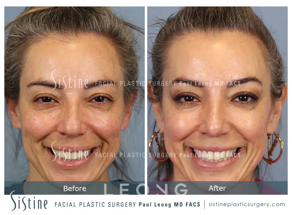 Rhinoplasty Before and After | Leong Facial Plastic Surgery