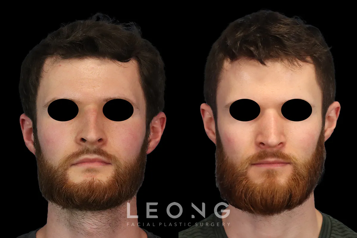 Rhinoplasty Before and After | Leong Facial Plastic Surgery