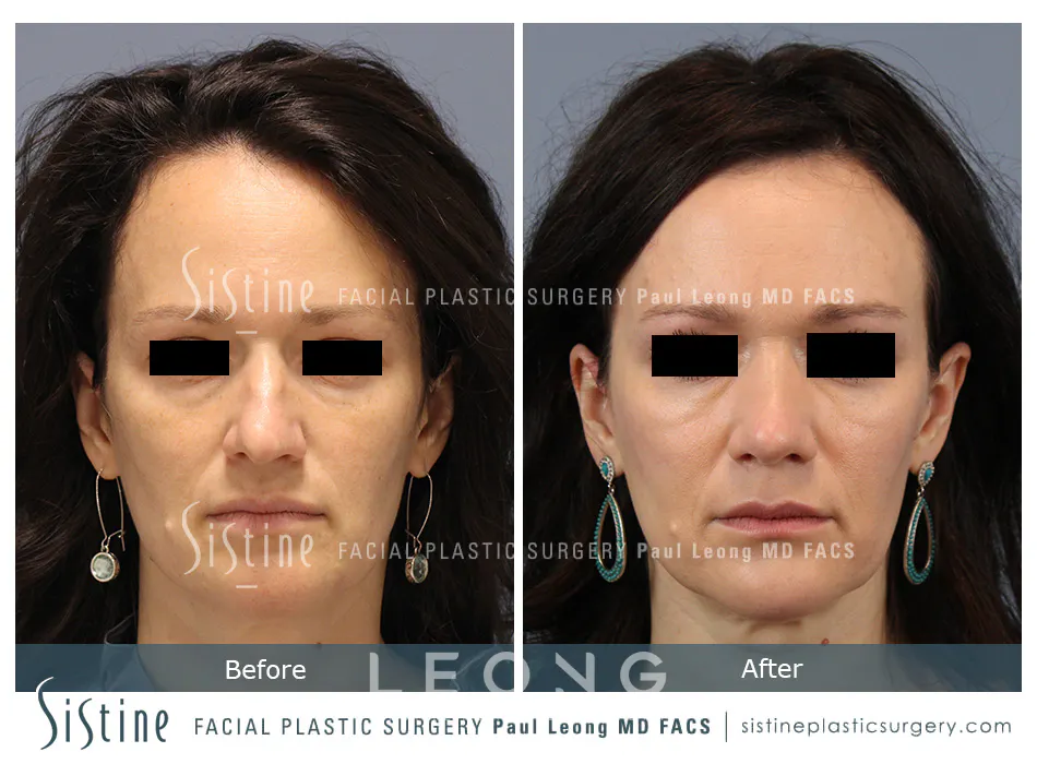 Rhinoplasty Before and After | Leong Facial Plastic Surgery