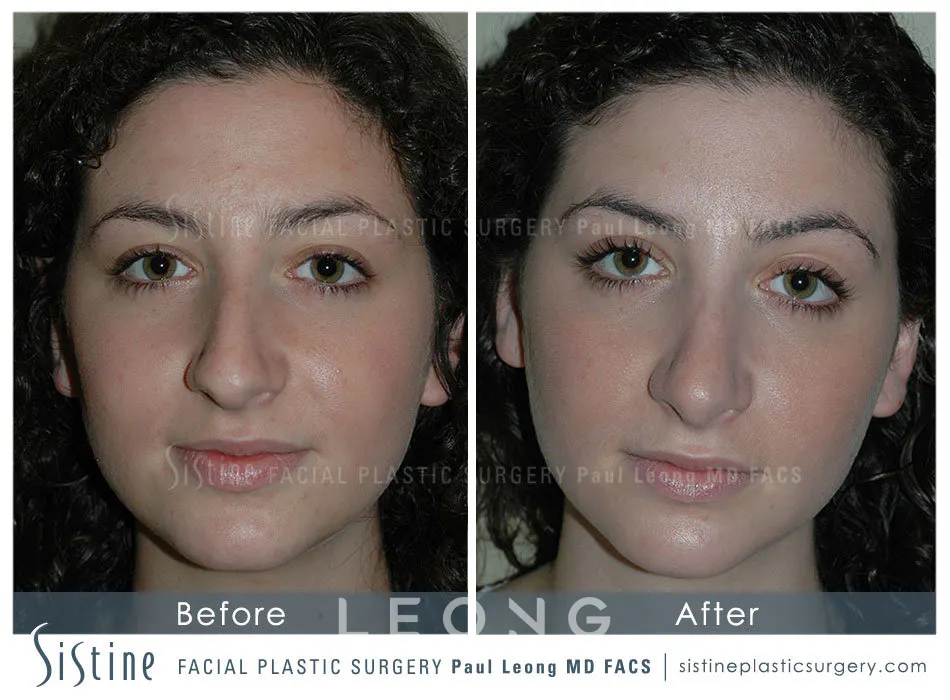 Rhinoplasty Before and After | Leong Facial Plastic Surgery