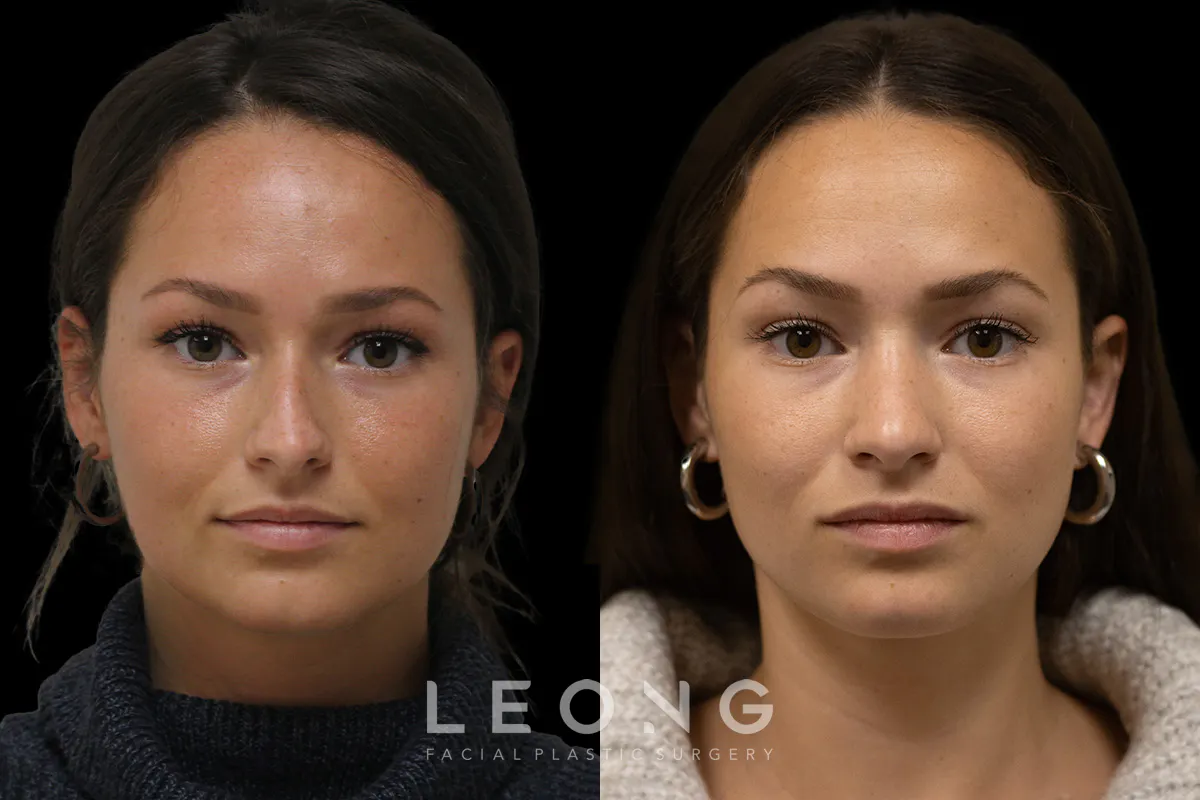 Rhinoplasty Before and After | Leong Facial Plastic Surgery