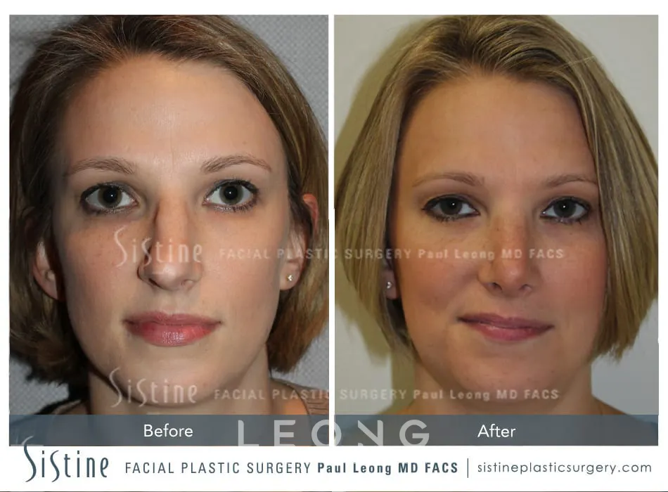 Rhinoplasty Before and After | Leong Facial Plastic Surgery