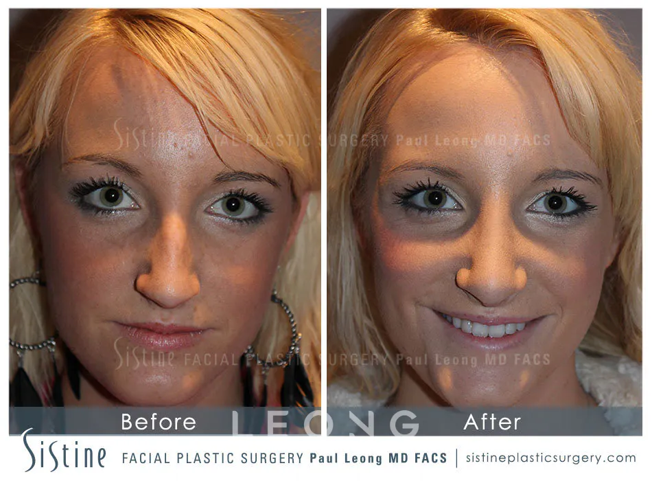 Rhinoplasty Before and After | Leong Facial Plastic Surgery