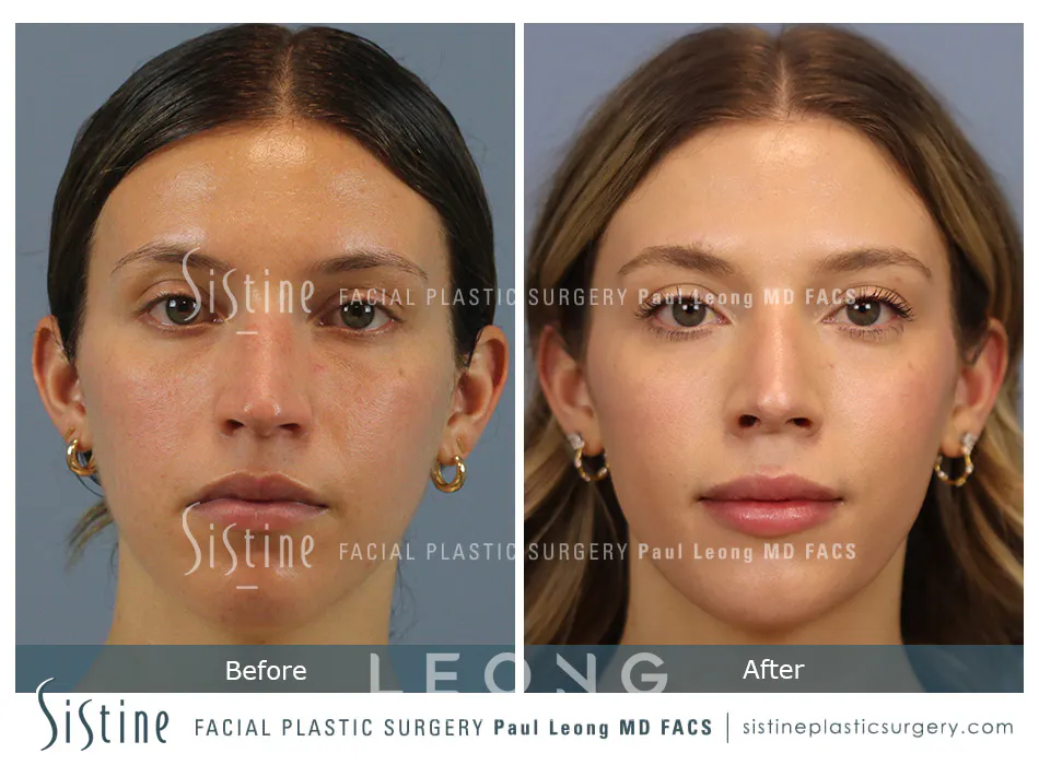 Rhinoplasty Before and After | Leong Facial Plastic Surgery