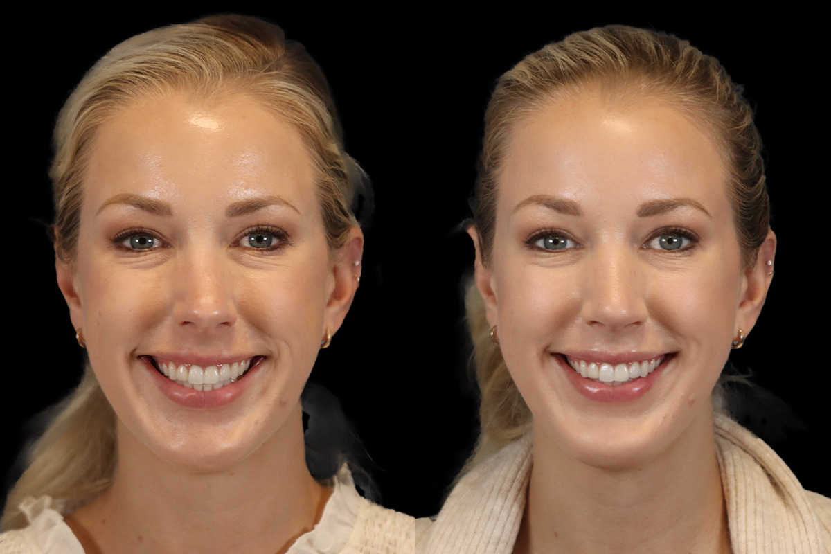 Rhinoplasty Before and After | Leong Facial Plastic Surgery