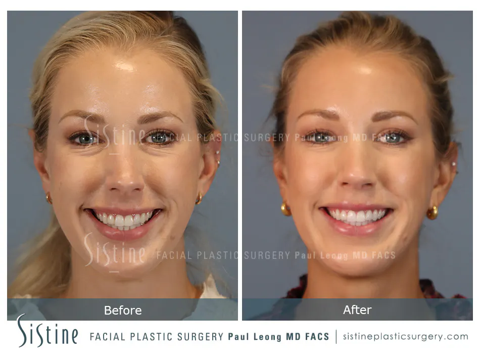 Rhinoplasty Before and After | Leong Facial Plastic Surgery
