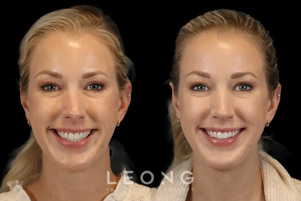 Rhinoplasty Before and After | Leong Facial Plastic Surgery