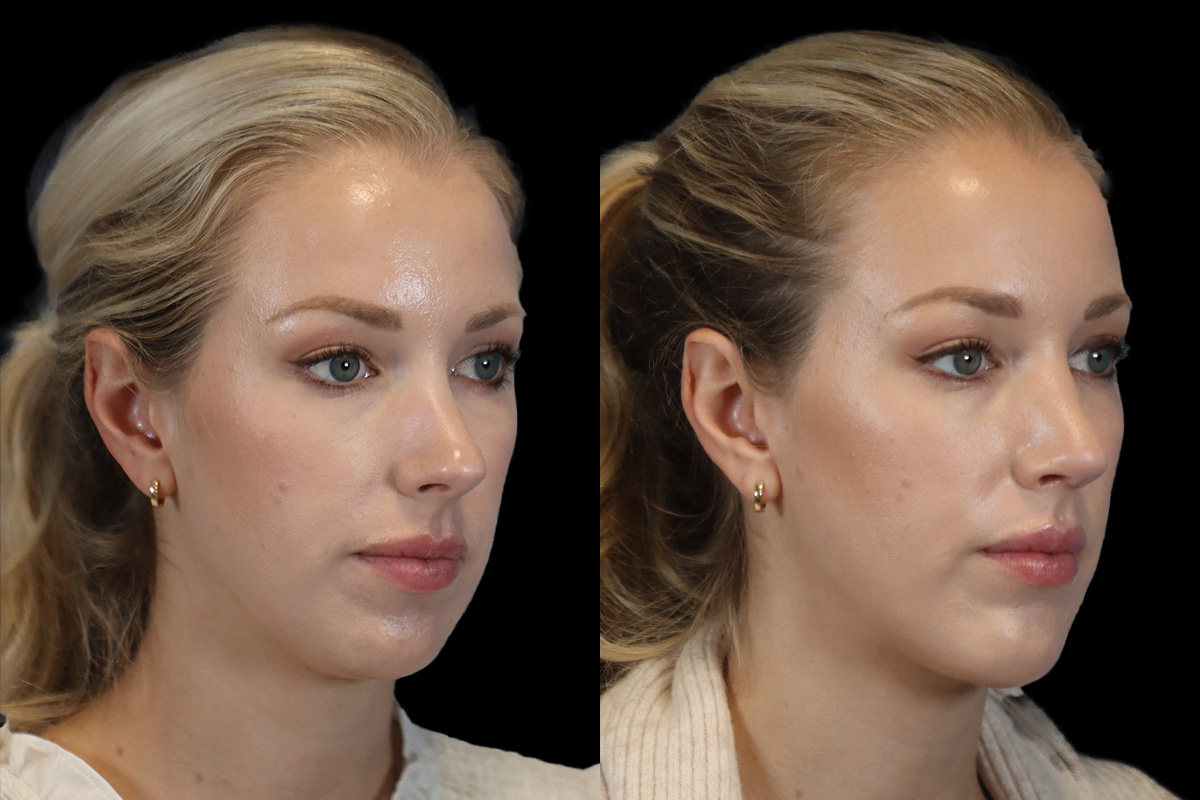 Rhinoplasty Before and After | Leong Facial Plastic Surgery