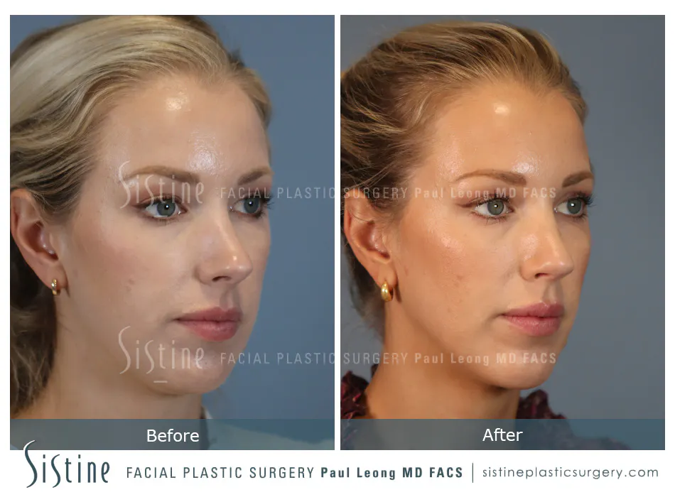 Rhinoplasty Before and After | Leong Facial Plastic Surgery