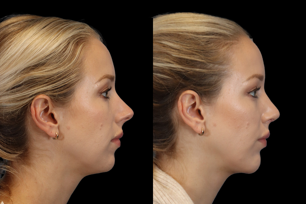 Rhinoplasty Before and After | Leong Facial Plastic Surgery