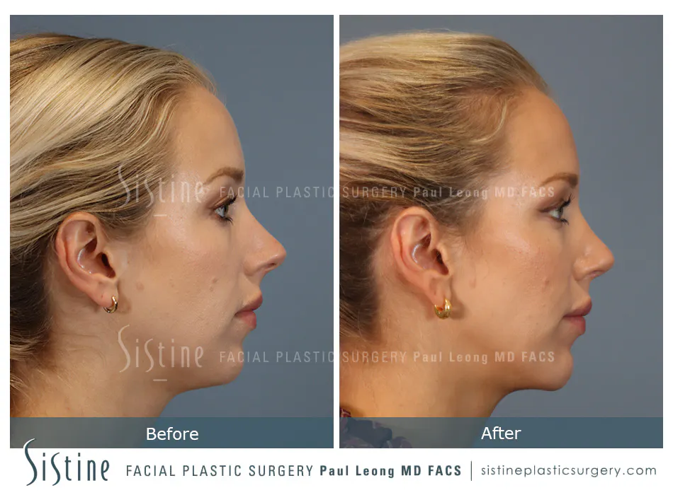 Rhinoplasty Before and After | Leong Facial Plastic Surgery