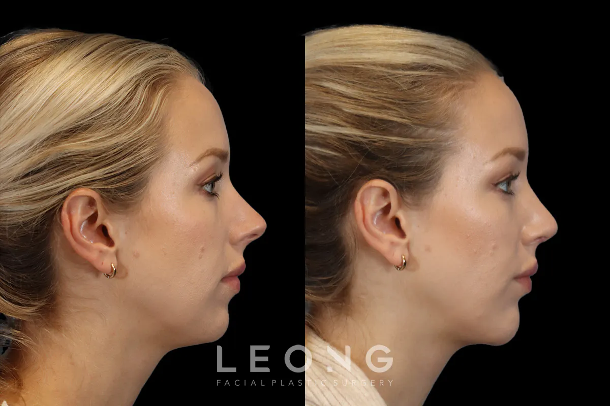 Rhinoplasty Before and After | Leong Facial Plastic Surgery