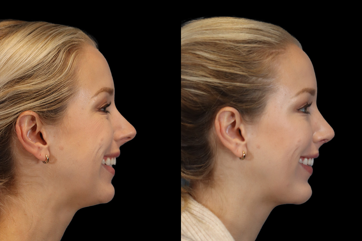 Rhinoplasty Before and After | Leong Facial Plastic Surgery