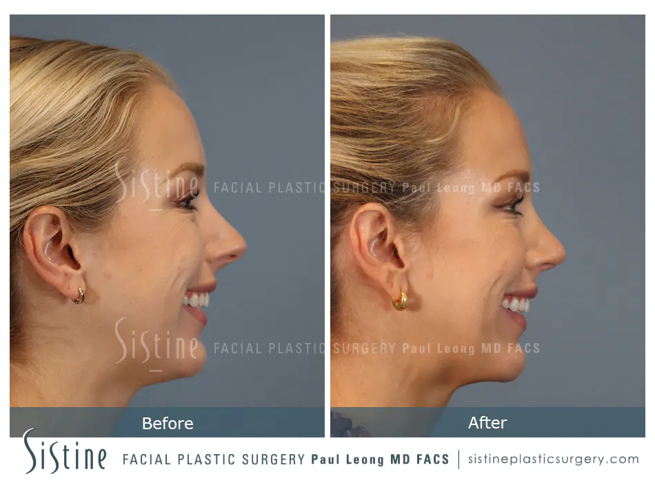 Rhinoplasty Before and After | Leong Facial Plastic Surgery