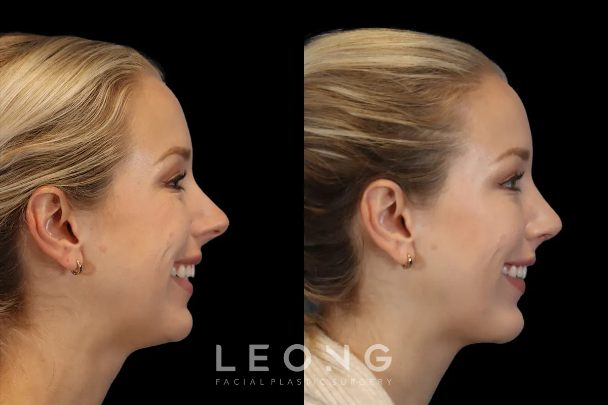 Rhinoplasty Before and After | Leong Facial Plastic Surgery