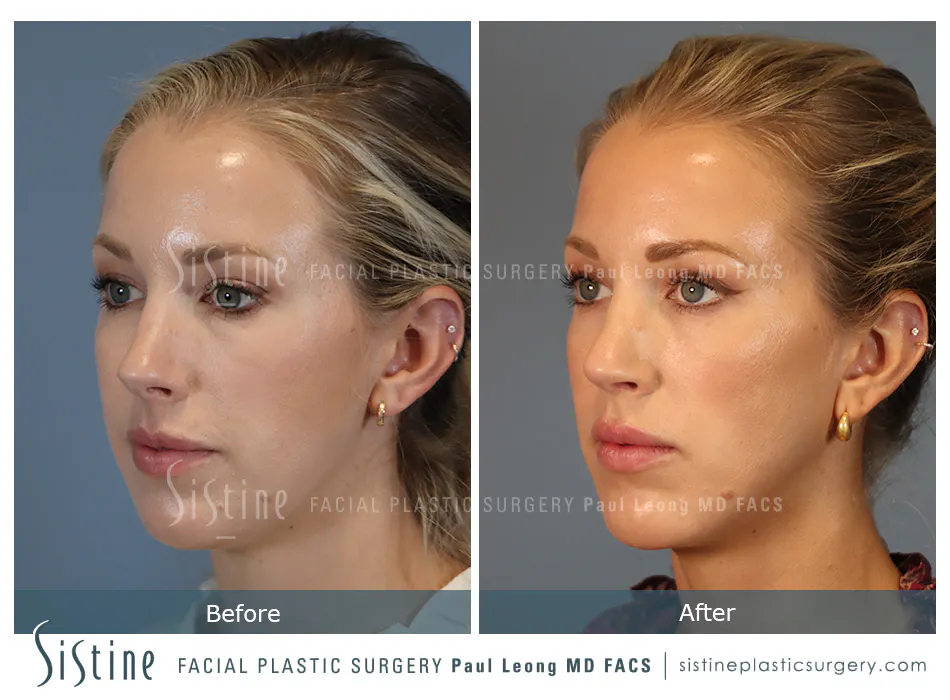 Rhinoplasty Before and After | Leong Facial Plastic Surgery