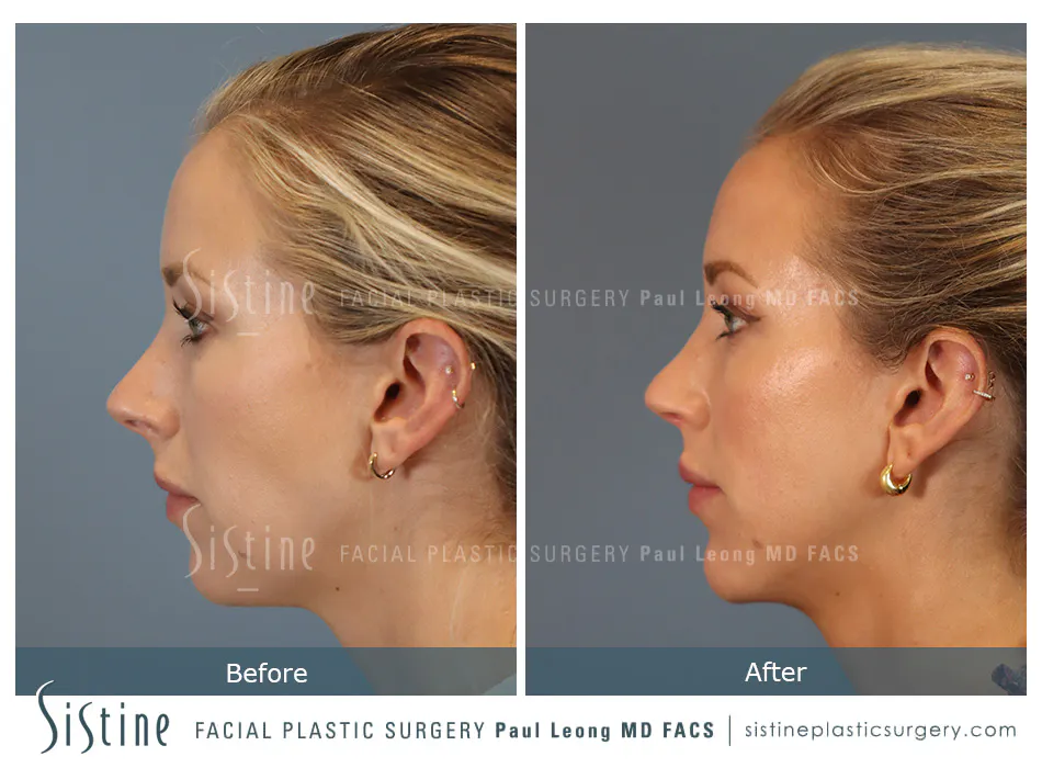 Rhinoplasty Before and After | Leong Facial Plastic Surgery