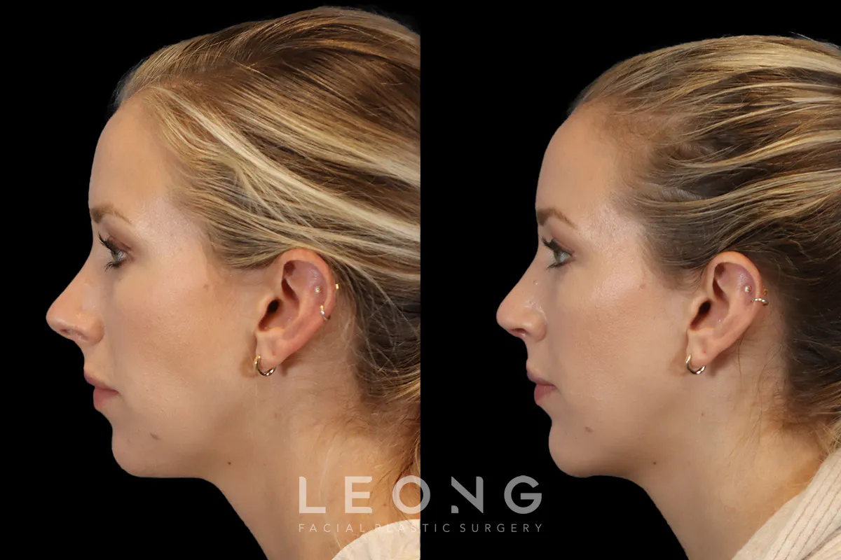 Rhinoplasty Before and After | Leong Facial Plastic Surgery