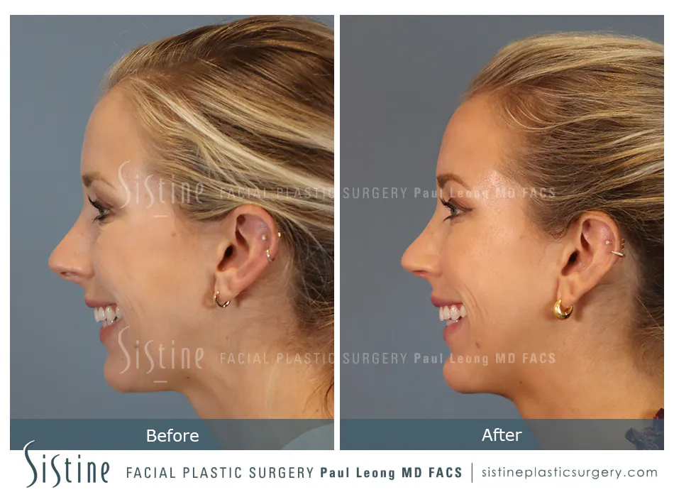 Rhinoplasty Before and After | Leong Facial Plastic Surgery