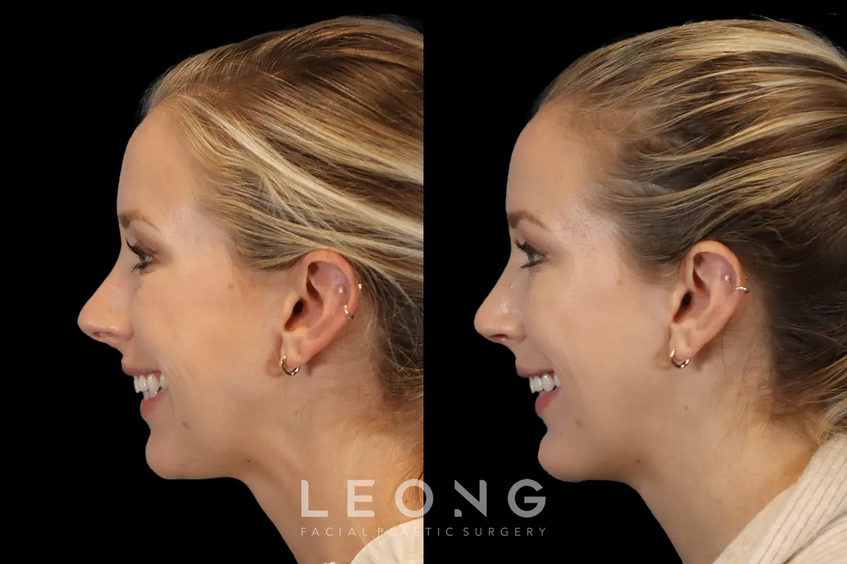 Rhinoplasty Before and After | Leong Facial Plastic Surgery