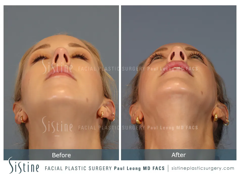Rhinoplasty Before and After | Leong Facial Plastic Surgery