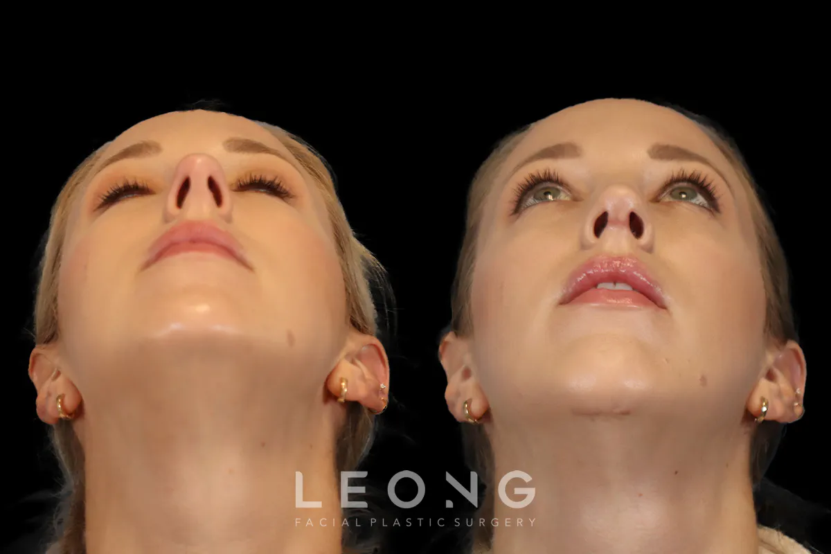 Rhinoplasty Before and After | Leong Facial Plastic Surgery