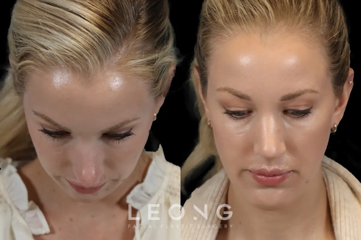 Rhinoplasty Before and After | Leong Facial Plastic Surgery