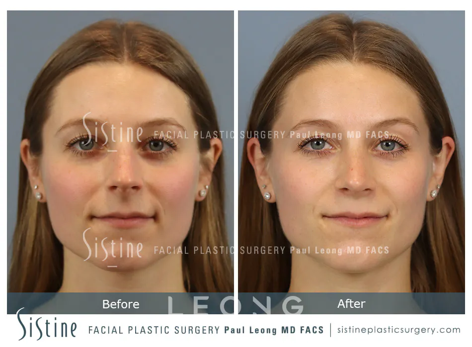 Rhinoplasty Before and After | Leong Facial Plastic Surgery