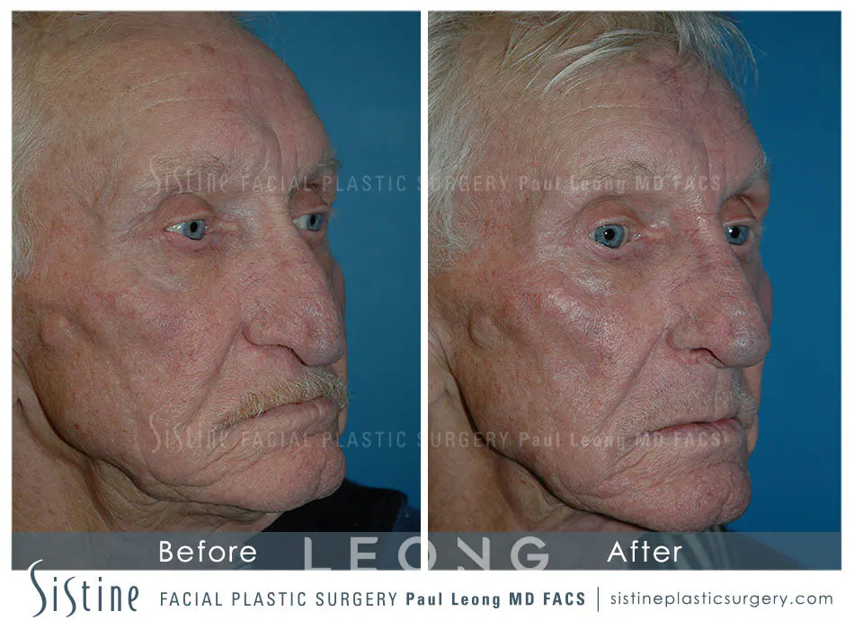 Rhinoplasty Before and After | Leong Facial Plastic Surgery