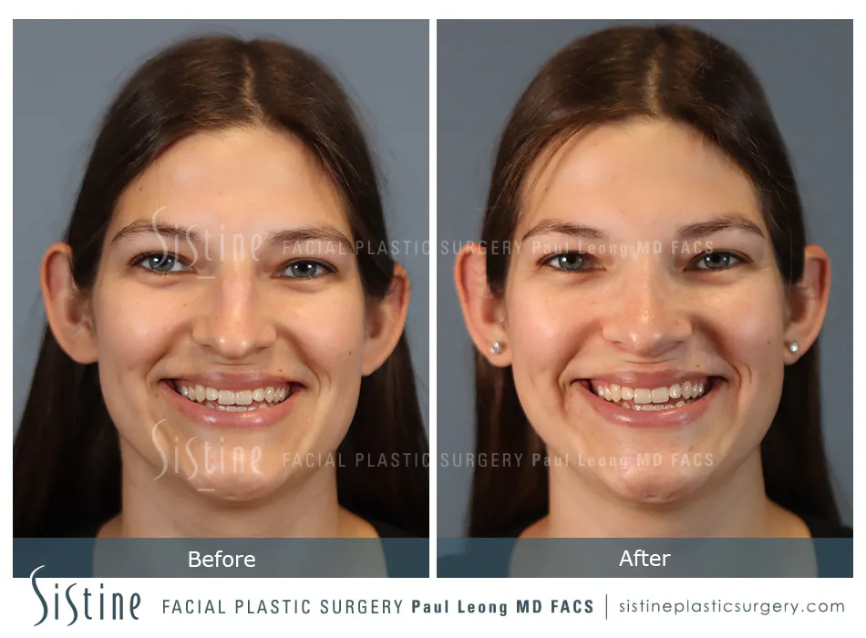 Rhinoplasty Before and After | Leong Facial Plastic Surgery