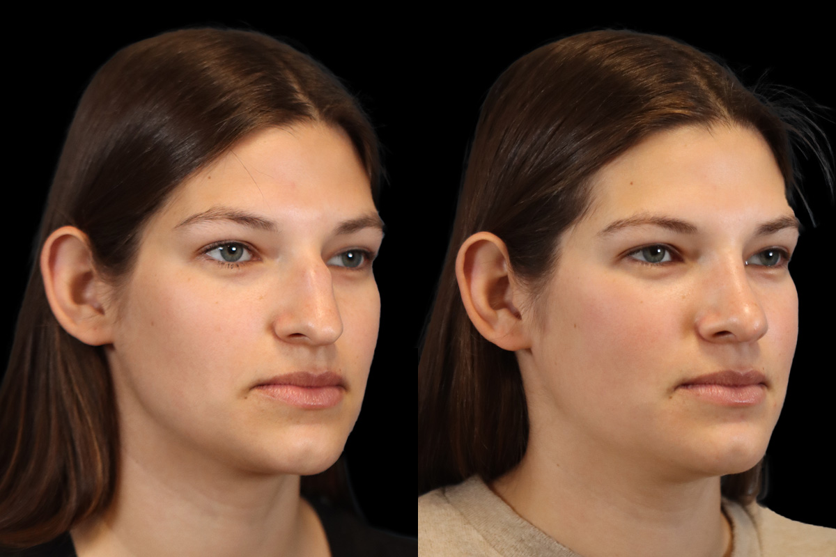 Rhinoplasty Before and After | Leong Facial Plastic Surgery