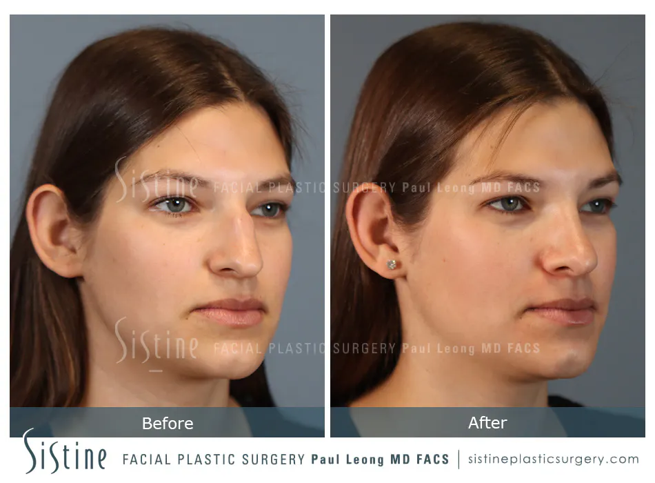 Rhinoplasty Before and After | Leong Facial Plastic Surgery