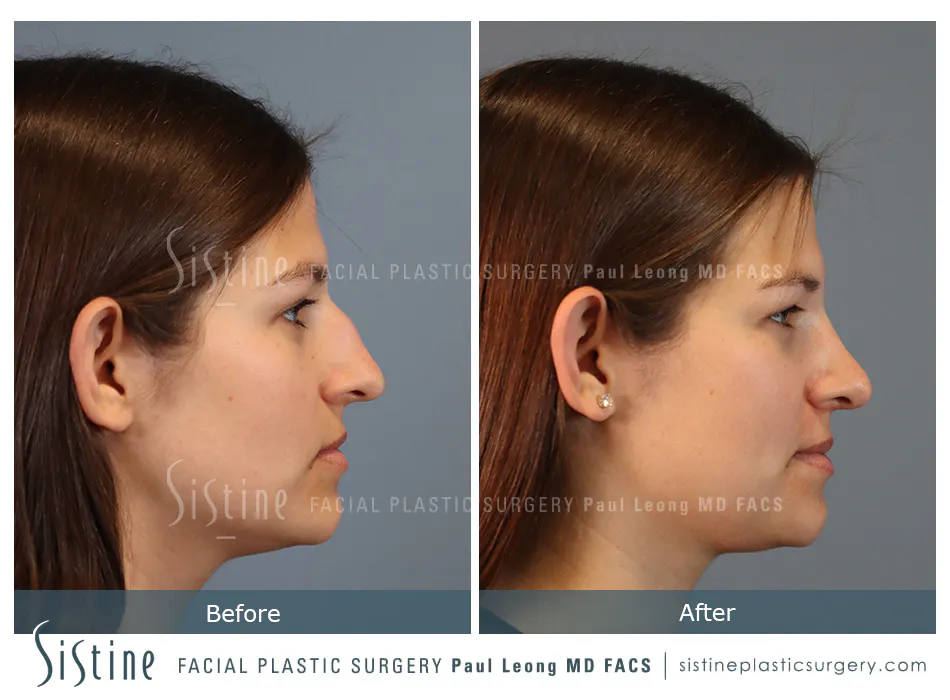 Nose Changes With Age - Preoperative View | Dr. Paul Leong