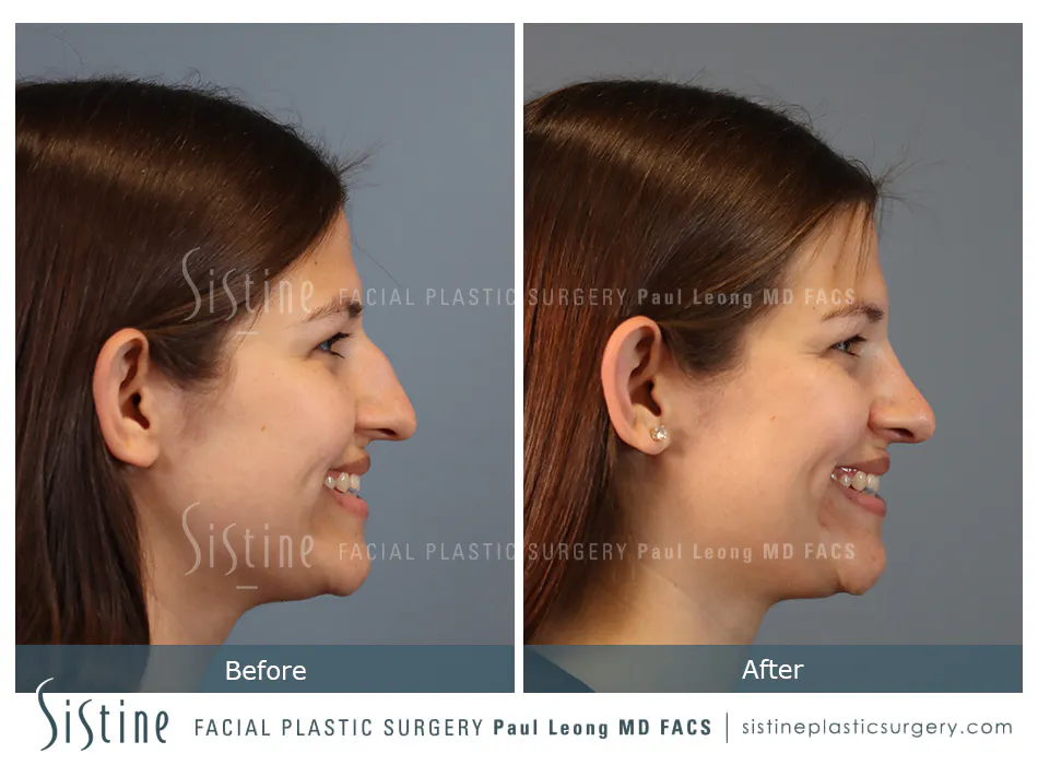 Nose Changes With Age - Preoperative View | Dr. Paul Leong