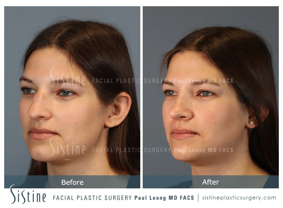 Nose Changes With Age - Preoperative View | Dr. Paul Leong