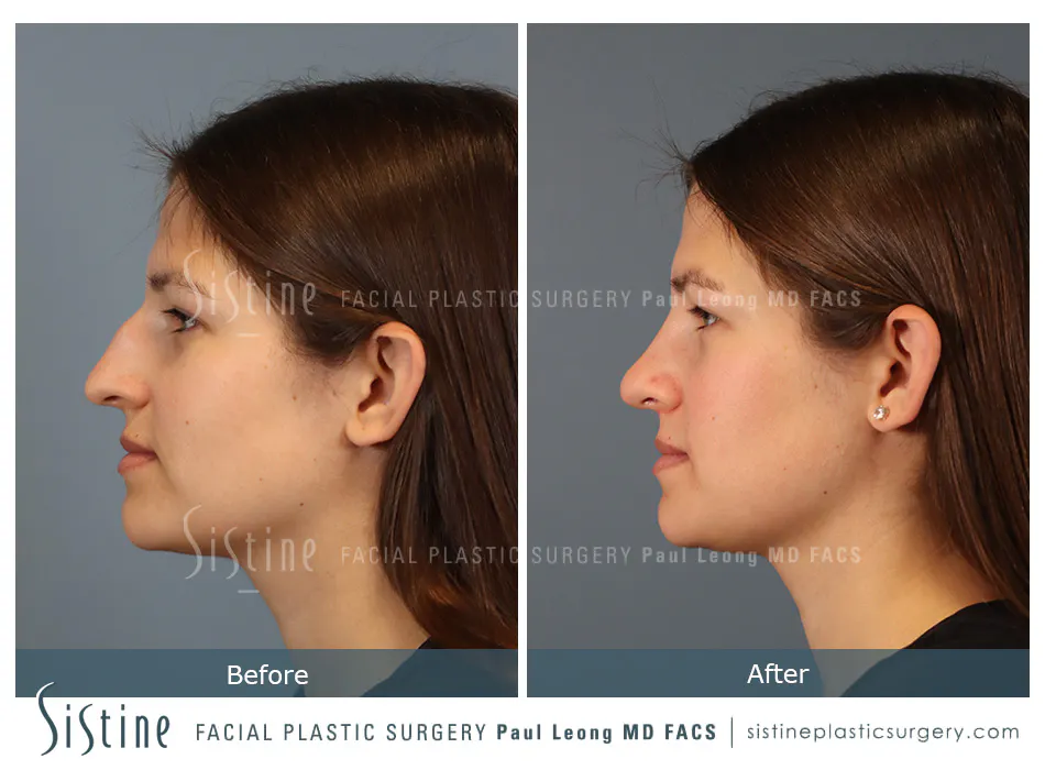 Nose Changes With Age - Preoperative View | Dr. Paul Leong