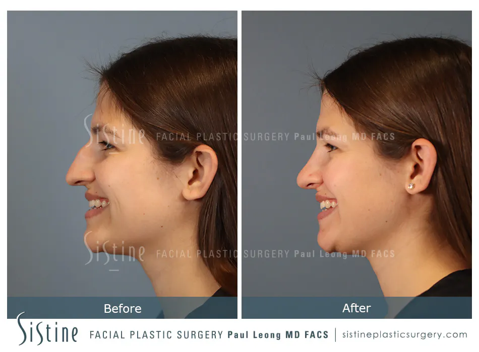 Nose Changes With Age - Preoperative View | Dr. Paul Leong