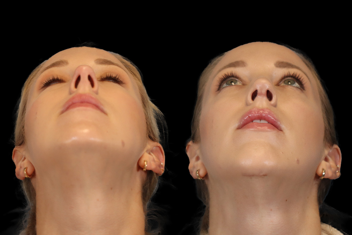 Nose Changes With Age - Preoperative View | Dr. Paul Leong