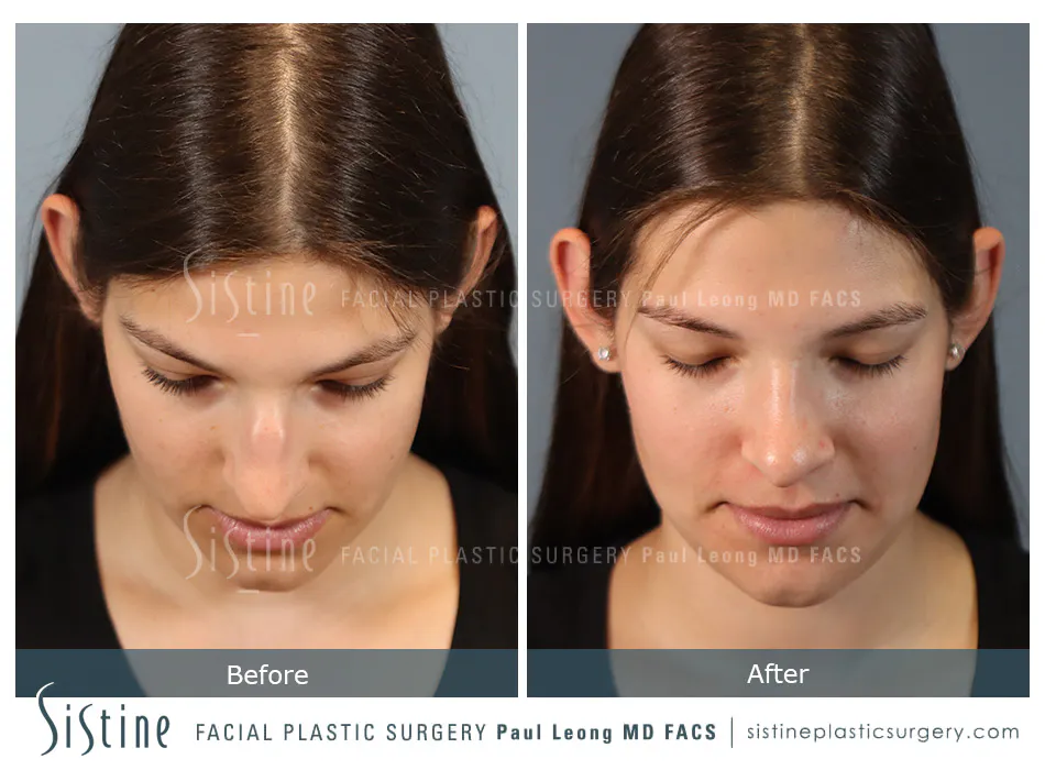 Nose Changes With Age - Preoperative View | Dr. Paul Leong