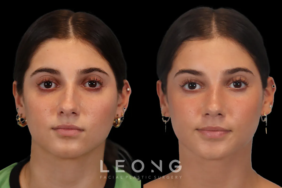 Rhinoplasty Before and After | Leong Facial Plastic Surgery