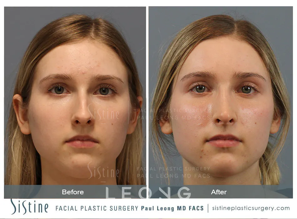Rhinoplasty Before and After | Leong Facial Plastic Surgery