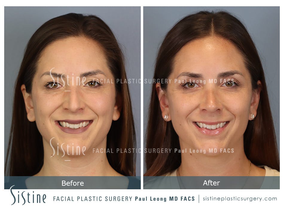 Rhinoplasty Before and After | Leong Facial Plastic Surgery