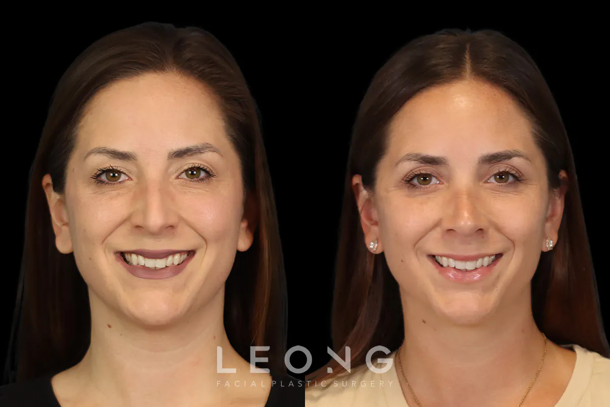 Rhinoplasty Before and After | Leong Facial Plastic Surgery