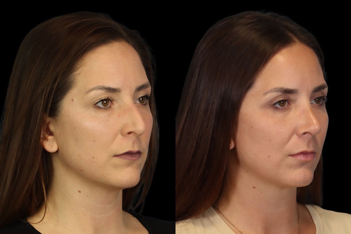 Rhinoplasty Before and After | Leong Facial Plastic Surgery