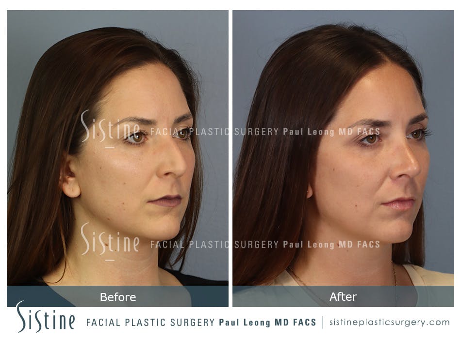 Rhinoplasty Before and After | Leong Facial Plastic Surgery
