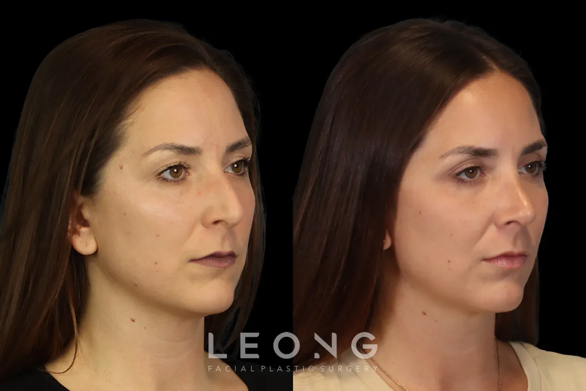 Rhinoplasty Before and After | Leong Facial Plastic Surgery