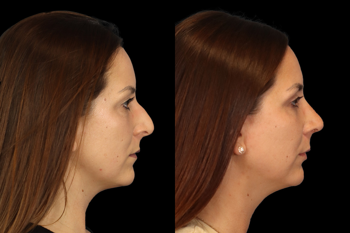 Rhinoplasty Before and After | Leong Facial Plastic Surgery